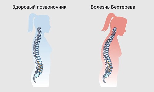 Болезнь Бехтерева: как распознать и остановить развитие.