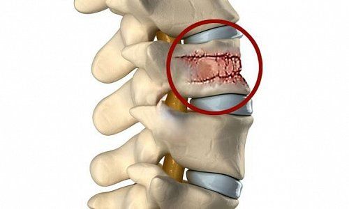 Разновидности переломов грудопоясничного отдела