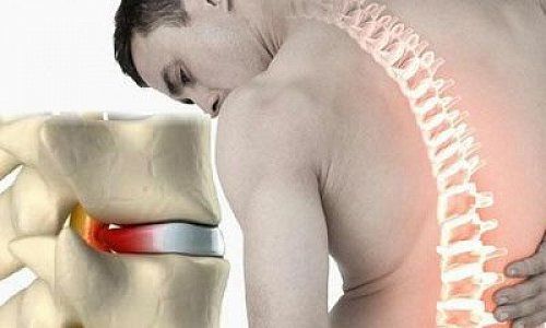 Что такое грыжа Шморля позвоночника? Симптомы и лечение