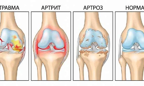 Артрит или артроз: как не перепутать?