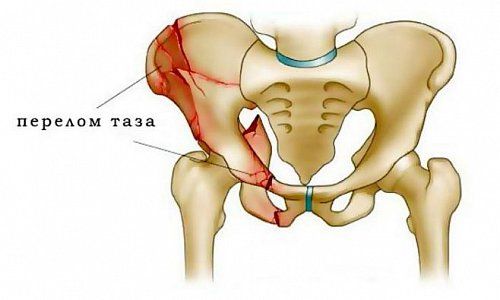 Переломы костей таза
