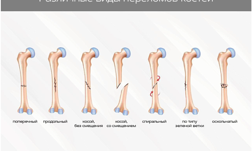 Какими бывают переломы и как после них восстановиться.