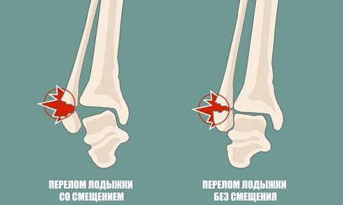 Переломы лодышек